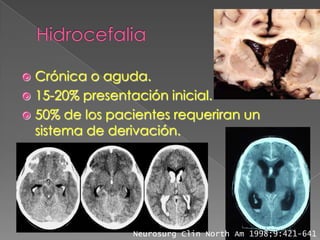  Crónica o aguda.
 15-20% presentación inicial.
 50% de los pacientes requeriran un
  sistema de derivación.




                Neurosurg Clin North Am 1998;9:421-641
 