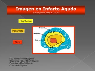 Imagen en Infarto Agudo
                          Lancet Neurol 2006; 5:755-768


           Oligohemia



   Penumbra



      Core




FSC normal: >50ml/100gr/min
Oligohemia: >20 a <50ml/100gr/min
Penumbra: <20ml/100gr/min
Core: <8ml/100gr/min
 