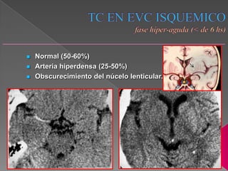    Normal (50-60%)
   Arteria hiperdensa (25-50%)
   Obscurecimiento del núcelo lenticular.
 