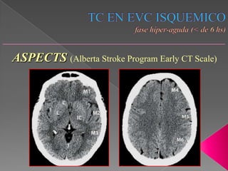 ASPECTS (Alberta Stroke Program Early CT Scale)
 