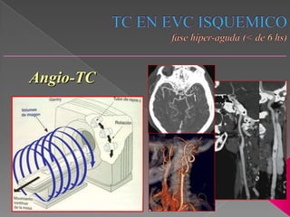 Angio-TC
 