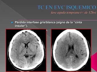   Pérdida interfase gris/blanca (signo de la “cinta
    insular”).
   Obliteración de surcos.
 