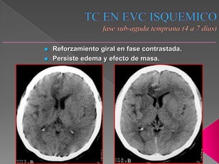    Reforzamiento giral en fase contrastada.
   Persiste edema y efecto de masa.
 