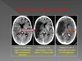 ¿Qué pacientes no deben ser tratados?




                                                           >3h ?




Patient A with early       Patient A with        Patient B with a
signs of extensive      demarcation of the      subacute infarction
 right hemispheric     infarct 72 hours later    on the right side
     infarction
 