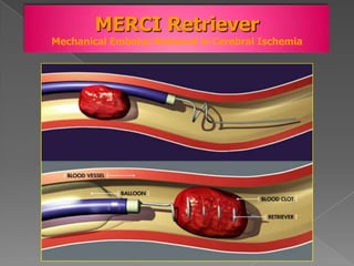 MERCI Retriever
Mechanical Embolus Removal in Cerebral Ischemia
 