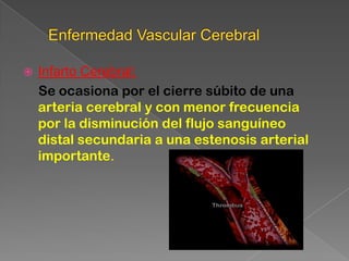    Infarto Cerebral:
    Se ocasiona por el cierre súbito de una
    arteria cerebral y con menor frecuencia
    por la disminución del flujo sanguíneo
    distal secundaria a una estenosis arterial
    importante.
 
