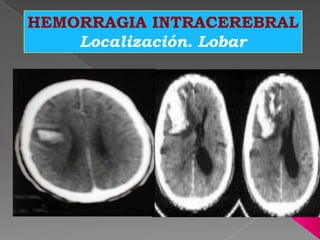 HEMORRAGIA INTRACEREBRAL
    Localización. Lobar
 