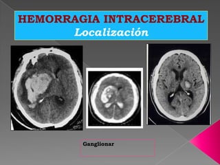 HEMORRAGIA INTRACEREBRAL
      Localización




        Ganglionar
 