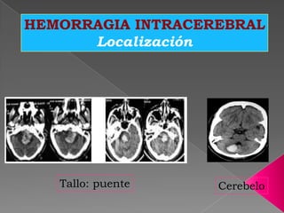 HEMORRAGIA INTRACEREBRAL
      Localización




   Tallo: puente   Cerebelo
 