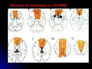 Ubicación de las lesiones en TAC-RNM
 