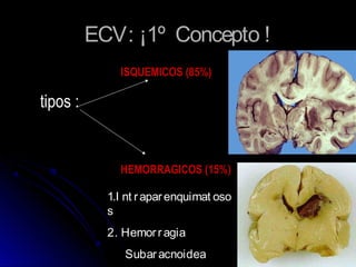 ECV: ¡1º Concepto !ECV: ¡1º Concepto !
ISQUEMICOS (85%)
tipos :
HEMORRAGICOS (15%)
1.I nt raparenquimat oso
s
2. Hemorragia
Subaracnoidea
 