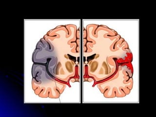 HemorragiaIsquemia (infarto)
 