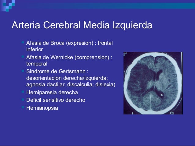 Enfermedad cerebro vascular