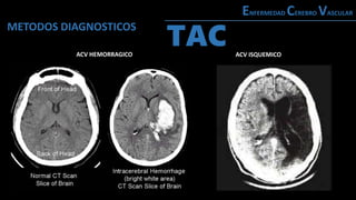 METODOS DIAGNOSTICOS
ENFERMEDAD CEREBRO VASCULAR
TAC
ACV HEMORRAGICO ACV ISQUEMICO
 