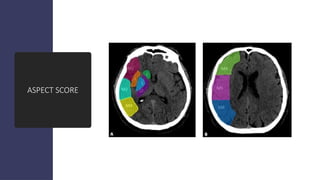 Enfermedad cerebrovascular Med. interno.pptx