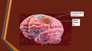 Infarto
Estadio
4°
Area penumbra
Estadio 3°-2°
 