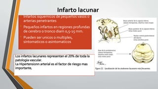 Infarto lacunar
• Infartos isquemicos de pequeños vasos o
arterias penetrantes
• Pequeños infartos en regiones profundas
de cerebro o tronco diam 0,5-15 mm.
• Pueden ser unicos o multiples,
sintomaticos o asintomaticos
Los infartos lacunares representan el 20% de toda la
patologia vascular.
La Hipertensionn arterial es el factor de riesgo mas
importante,
 
