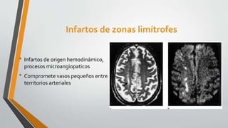 Infartos de zonas limítrofes
• Infartos de origen hemodinámico,
procesos microangiopaticos
• Compromete vasos pequeños entre
territorios arteriales
 