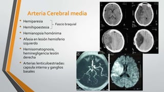 Arteria Cerebral media
• Hemiparesia
• Hemihipoestesia
• Hemianopsia homónima
• Afasia en lesión hemisferio
izquierdo
• Hemisomatognosia,
heminegligencia lesión
derecha
• Arterias lenticuloestriadas:
capsula interna y ganglios
basales
Fascio braquial
 