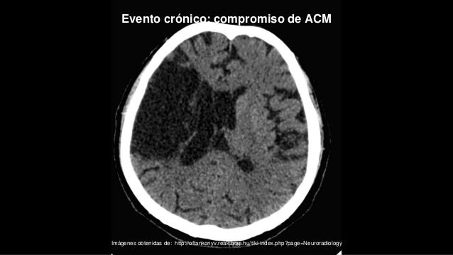 Enfermedad cerebrovascular isquémica ACEMCAL