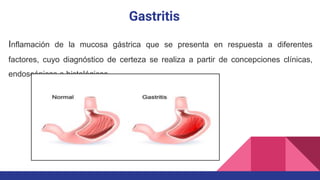 Gastritis
Inflamación de la mucosa gástrica que se presenta en respuesta a diferentes
factores, cuyo diagnóstico de certeza se realiza a partir de concepciones clínicas,
endoscópicas e histológicas.
 