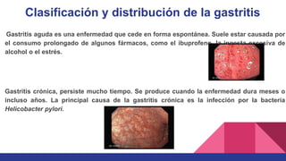 Clasificación y distribución de la gastritis
Gastritis aguda es una enfermedad que cede en forma espontánea. Suele estar causada por
el consumo prolongado de algunos fármacos, como el ibuprofeno, la ingesta excesiva de
alcohol o el estrés.
Gastritis crónica, persiste mucho tiempo. Se produce cuando la enfermedad dura meses o
incluso años. La principal causa de la gastritis crónica es la infección por la bacteria
Helicobacter pylori.
 