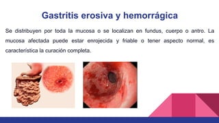 Gastritis erosiva y hemorrágica
Se distribuyen por toda la mucosa o se localizan en fundus, cuerpo o antro. La
mucosa afectada puede estar enrojecida y friable o tener aspecto normal, es
característica la curación completa.
 