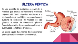 ÚLCERA PÉPTICA
Es una pérdida de sustancias a nivel de la
mucosa que alcanza la muscularis mucosae,
regiones del tracto digestivo expuestas a la
acción del ácido clorhídrico, precisando como
sustrato la existencia de mucosa de tipo
gástrico o áreas de metaplasia gástrica.
Cuando la pérdida de sustancia no alcanza la
submucosa se habla de erosiones.
La úlcera aguda dura menos de dos semanas
y la úlcera crónica más de dicho tiempo.
 