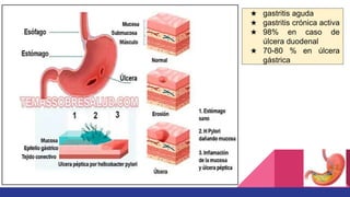 ★ gastritis aguda
★ gastritis crónica activa
★ 98% en caso de
úlcera duodenal
★ 70-80 % en úlcera
gástrica
 