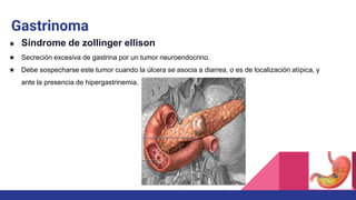 Gastrinoma
★ Síndrome de zollinger ellison
★ Secreción excesiva de gastrina por un tumor neuroendocrino.
★ Debe sospecharse este tumor cuando la úlcera se asocia a diarrea, o es de localización atípica, y
ante la presencia de hipergastrinemia.
 
