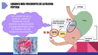 LUGARES MÁS FRECUENTES DE LA ÚLCERA
PÉPTICA
Las úlceras se van a
producir cuando la
barrera de mucus
protector se descompone
y el jugo estomacal entra
en contacto con las
células de recubrimiento.
curvatura menor
bulbo duodenal
esofago
curvatura
mayor
píloro
U. D
U.G.
 