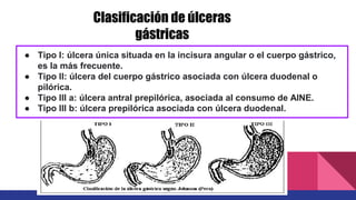 ● Tipo I: úlcera única situada en la incisura angular o el cuerpo gástrico,
es la más frecuente.
● Tipo II: úlcera del cuerpo gástrico asociada con úlcera duodenal o
pilórica.
● Tipo III a: úlcera antral prepilórica, asociada al consumo de AINE.
● Tipo III b: úlcera prepilórica asociada con úlcera duodenal.
Clasificación de úlceras
gástricas
 
