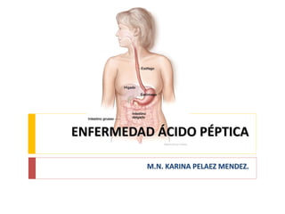 ENFERMEDAD ÁCIDO PÉPTICA
M.N. KARINA PELAEZ MENDEZ.
 