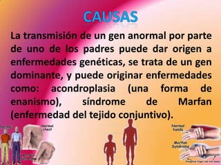 CAUSAS	La transmisión de un gen anormal por parte de uno de los padres puede dar origen a enfermedades genéticas, se trata de un gen dominante, y puede originar enfermedades como: acondroplasia (una forma de enanismo), síndrome de Marfan (enfermedad del tejido conjuntivo). 