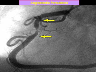 Angioplastía Percutánea
 