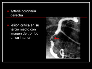    Arteria coronaria
    derecha

   lesión crítica en su
    tercio medio con
    imagen de trombo
    en su interior
 