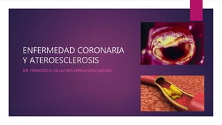 ENFERMEDAD CORONARIA
Y ATEROESCLEROSIS
DR. FRANCISCO VILLACRES FERNANDEZ,MD,MG
 