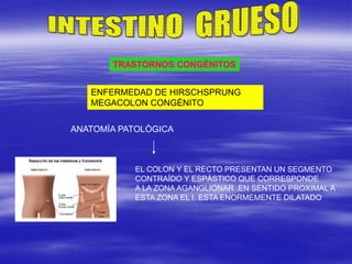 TRASTORNOS CONGÈNITOS
ENFERMEDAD DE HIRSCHSPRUNG
MEGACOLON CONGÈNITO
ANATOMÌA PATOLÒGICA
EL COLON Y EL RECTO PRESENTAN UN SEGMENTO
CONTRAÌDO Y ESPÀSTICO QUE CORRESPONDE
A LA ZONA AGANGLIONAR .EN SENTIDO PROXIMAL A
ESTA ZONA EL I. ESTA ENORMEMENTE DILATADO
 
