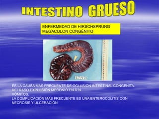 ENFERMEDAD DE HIRSCHSPRUNG
MEGACOLON CONGÈNITO
ES LA CAUSA MAS FRECUENTE DE OCLUSIÒN INTESTINAL CONGÈNITA.
RETRASO EXPULSIÒN MECONIO EN R.N.
VÒMITOS.
LA COMPLICACIÒN MAS FRECUENTE ES UNA ENTEROCOLITIS CON
NECROSIS Y ULCERACIÒN
 