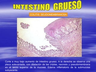 COLITIS SEUDOMEMBRANOSA
Corte a muy bajo aumento de intestino grueso. A la derecha se observa una
placa solevantada, con dilatación de las criptas, necrosis y pseudomembrana
en el tercio superior de la mucosa. Edema inflamatorio de la submucosa
subyacente.
 
