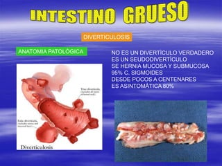 DIVERTICULOSIS
ANATOMIA PATOLÒGICA NO ES UN DIVERTÌCULO VERDADERO
ES UN SEUDODIVERTÌCULO
SE HERNIA MUCOSA Y SUBMUCOSA
95% C. SIGMOIDES
DESDE POCOS A CENTENARES
ES ASINTOMÀTICA 80%
 