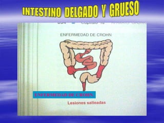 ENFERMEDAD DE CROHN.
 