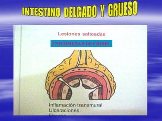 ENFERMEDAD DE CROHN.
 