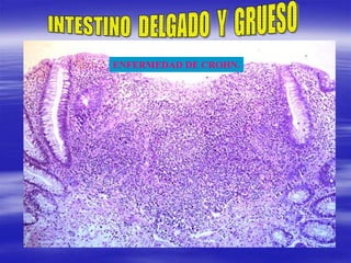 ENFERMEDAD DE CROHN.
 