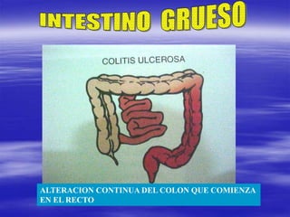 ALTERACION CONTINUA DEL COLON QUE COMIENZA
EN EL RECTO
 