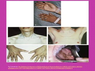 Fig 2 tomada de: http://biblioteca.fucsalud.edu.co:2052/books/figure.do?figure=true&eid=4-u1.0-B978-1-4377-0324-5..00015-8--s0520&isbn=978-1-4377-0324-5&figureEid=4-u1.0-B978-1-4377-0324-5..00015-8--f0165&uniqId=270055627-3