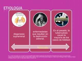 etiologia4352bibliografiaFig  3:  http://www.google.com.co/imgres?q=suprarrenal&hl=es&gbv=2&tbm=isch&tbnid=YQAVJ6iYSUWU-M:&imgrefurl=http://teknon.es/consultorio/diez-caballero/suprarrenal.htm&docid=QeOD_9hZQKVb4M&w=150&h=171&ei=us84TofKA9G4twfNzJHlAg&zoom=1&iact=rc&dur=519&page=1&tbnh=136&tbnw=120&start=0&ndsp=13&ved=1t:429,r:2,s:0&tx=60&ty=59&biw=1024&bih=589
