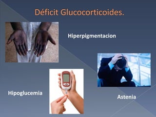 Déficit Glucocorticoides.HiperpigmentacionHipoglucemiaAstenia