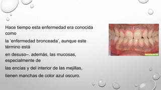 Hace tiempo esta enfermedad era conocida
como
la ‘enfermedad bronceada’, aunque este
término está
en desuso–. además, las mucosas,
especialmente de
las encías y del interior de las mejillas,
tienen manchas de color azul oscuro.
 