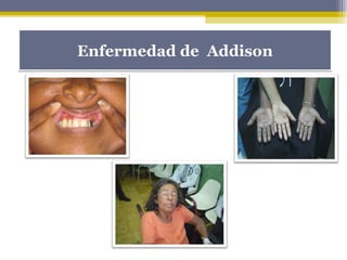 Enfermedad de AddisonEnfermedad de Addison
 